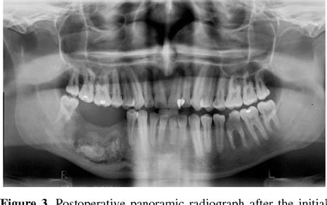 [PDF] Mandibular cementoblastoma: Case report | Semantic Scholar