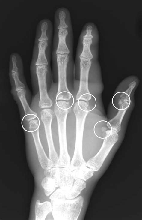 Sesamoid Bone Hand