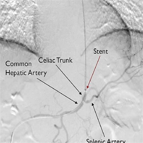 Imaging of the placement of balloon-mounted bare metal stent within the ...