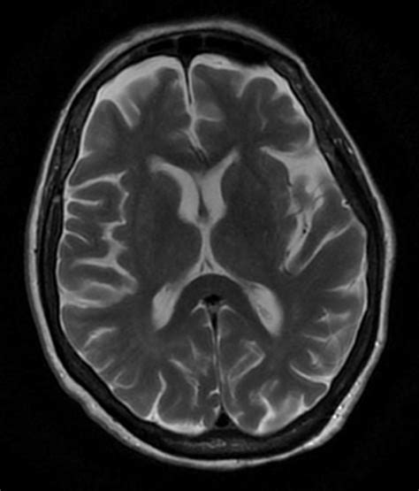 A case of large right MCA stroke with hyperdense MCA sign in CT imaging ...