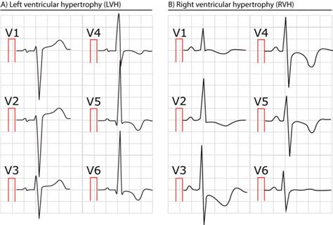 ECG in left ventricular hypertrophy (LVH): criteria and implications ...