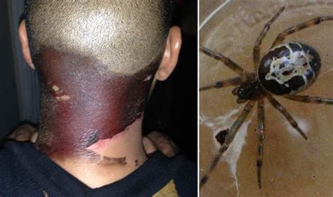 PICTURED: False widow spider bite turned my neck BLACK | UK | News ...