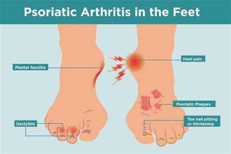 Psoriatic Arthritis in the Feet: Symptoms, Treatment, Home Remedies