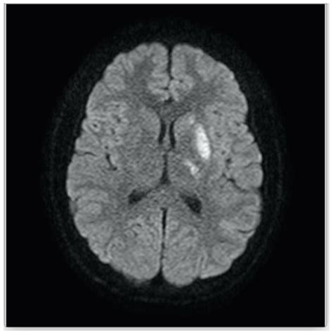 Children | Free Full-Text | Middle Cerebral Artery Stroke as Amusement ...