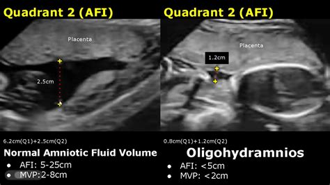 Amniotic Fluid Volume Ultrasound Normal Vs Abnormal | Oligohydramnios ...