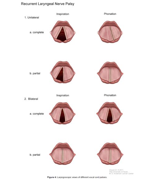 Paradoxical Vocal Cord Syndrome - Captions More