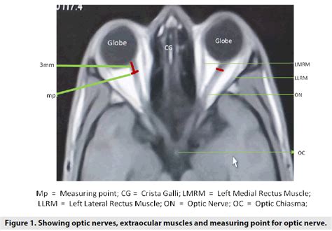 Normal Optic Nerve Mri