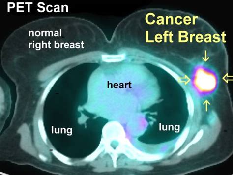 PET Scans in Cancer Cases