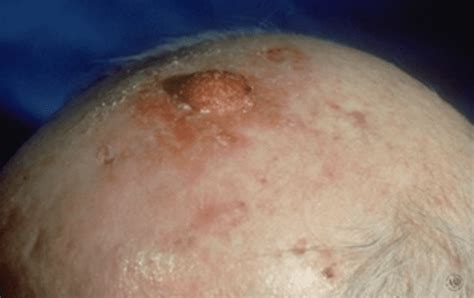 Squamous Cell Carcinoma: Diagnosis, Risks, Treatment & Prevention