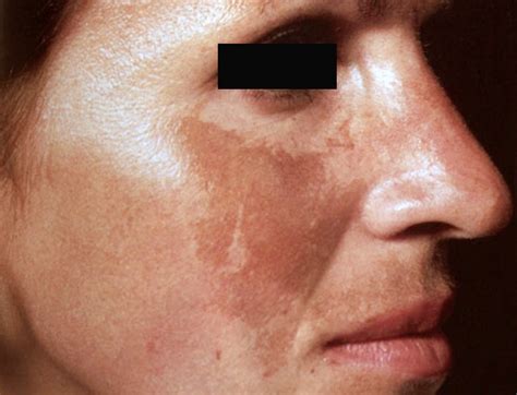 👉 Melasma - Treatment, Pictures, Symptoms, Causes (January 2022)