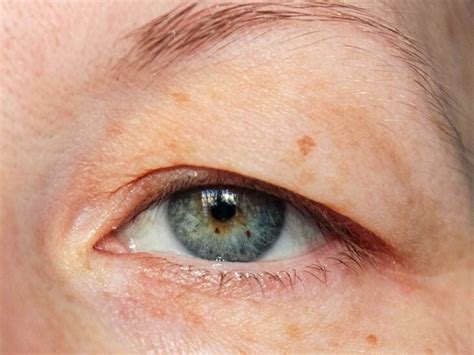 Droopy Eyelid Images - Infoupdate.org