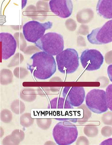 Acute leukemia | Osmosis