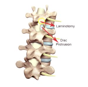 Laminotomy Procedure | Minimally Invasive | Spine Laser Institutes