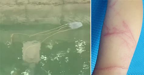 What to do if you're stung by a box jellyfish in S'pore: Don't pee on ...