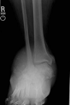 Charcot Shoulder Radiology : Charcot shoulder | Radiology Case ...