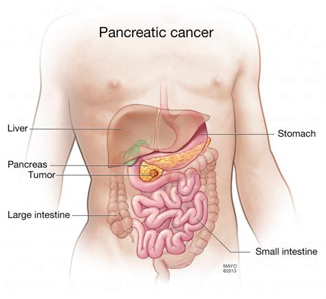 Surgery an option for more pancreatic cancer patients, Mayo expert says