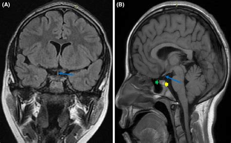 Normal pituitary MRI in coronal (A) and sagittal (B) sections showing ...