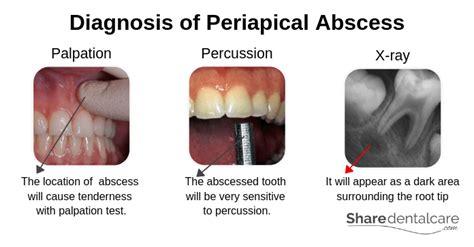 Periapical Abscess Treatment