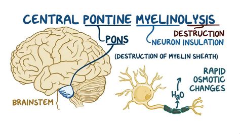 Central pontine myelinolysis - Osmosis