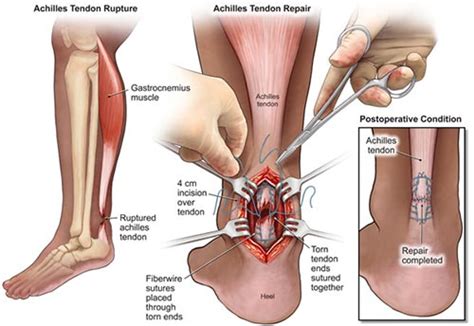 Achilles Tendon Surgery NYC | Achilles Tendon Tear Repair