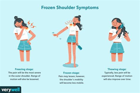 Frozen Shoulder and Thyroid Disease