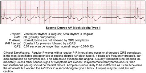 Atrioventricular Blocks - ACLS Wiki