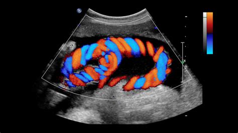 COLOUR DOPPLER - Aman Diagnostic Centre in Rewari