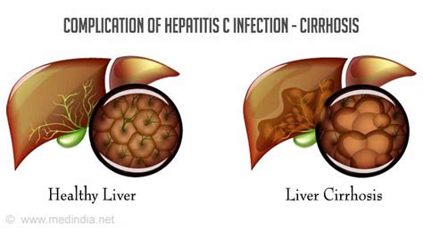 Hepatitis C Liver Disease