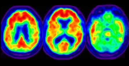 Should My Patient Get an Amyloid PET Scan for the Diagnosis of Alzheimers?