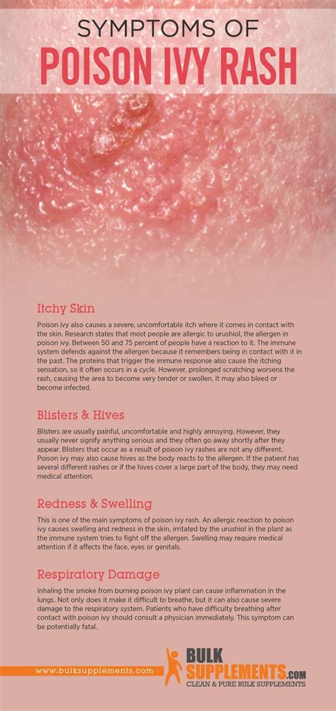 Poison Ivy Rash: Stages, Causes, Symptoms & Treatment