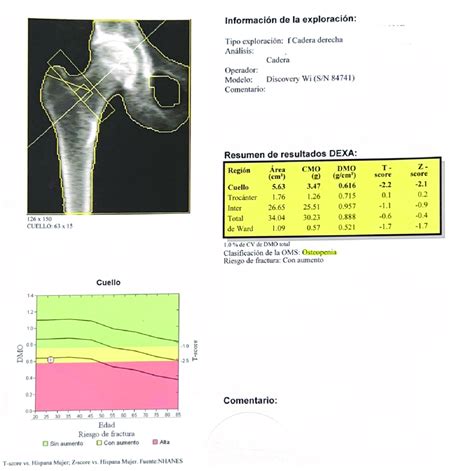 Densitometría ósea de cadera, donde se diagnosticó de osteopenia ...