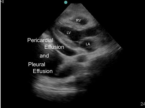 Pleural Effusion On Ultrasound