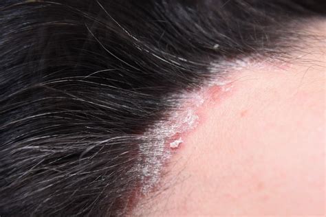 Scalp Psoriasis Treatment: What Works? - Riverchase Dermatology