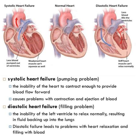 Systolic VS Diastolic Heart Failure College Nursing, Nursing School ...