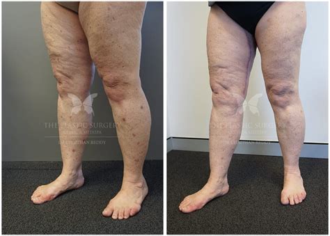 Thigh Lift Gallery | Before and After | Dr Reddy Sydney