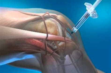 Stem Cell Injection Alternative To Knee Replacement? - SeniorsSkiing.com