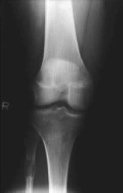 Fibrous Cortical Defect (Nonossifying Fibroma) Workup: Plain ...