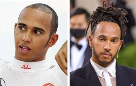 Lewis Hamilton Hair Transplant: Everything You Need to Know