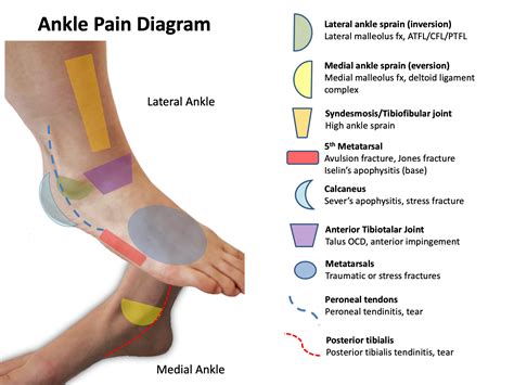 Foot Pain Identifier Chart Tendon