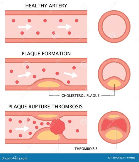 [DIAGRAM] Diagram Of Blood Vessels Developing Atherosclerosis ...