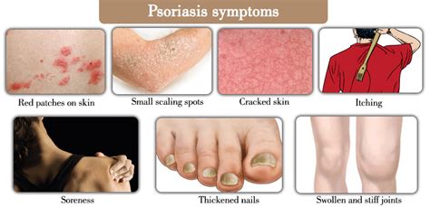 Discussion on Psoriasis: Part 1