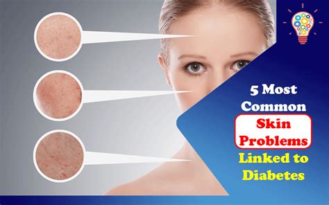 5 Most Common Skin Problems Linked to Diabetes – Updated Ideas