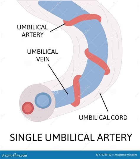 Single Umbilical Artery. Anatomy of Umbilical Cord with One Umbilical ...