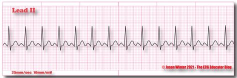 ECG Educator Blog : Sinus Tachycardia