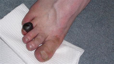 Blood Blister: Symptoms, Causes, Diagnosis