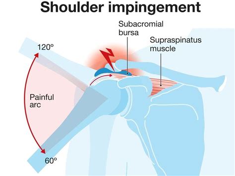 Shoulder Impingement Syndrome: Causes, Symptoms, & Treatment