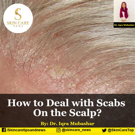 How to Deal with Scabs On the Scalp?