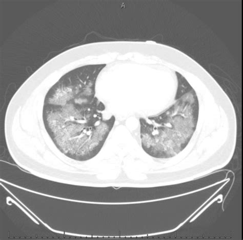 emDOCs.net – Emergency Medicine EducationDiffuse Alveolar Hemorrhage in ...