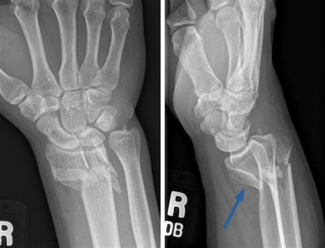 Smith Fracture