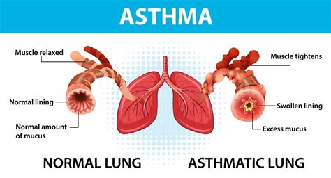 Bronchial Asthma diagram with normal lung and asthmatic lung 3567446 ...